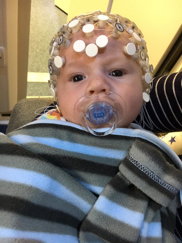 A two-month-old infant looking into the camera with a dummy in their mouth, wrapped in a striped blanket. They're wearing a neurological device on their head to measure their brain activity.
