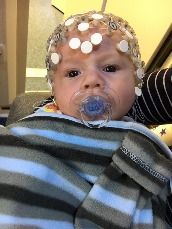 A two-month-old infant looking into the camera with a dummy in their mouth, wrapped in a striped blanket. They&#x27;re wearing a neurological device on their head to measure their brain activity.