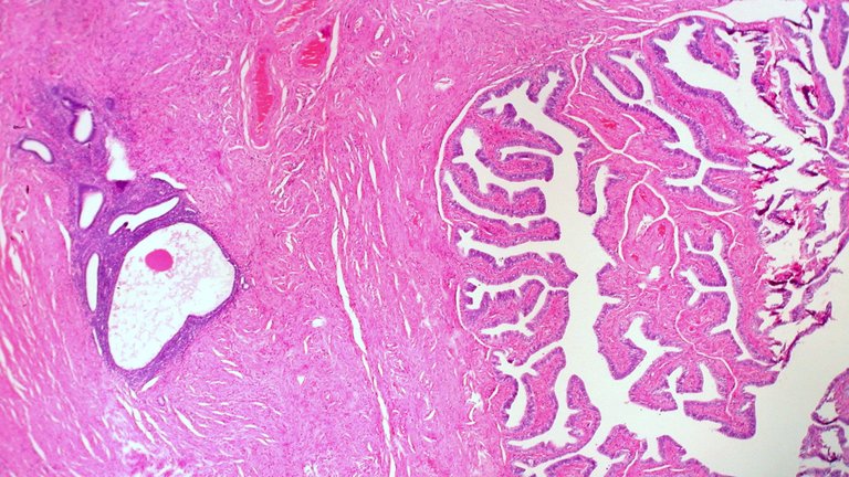 Endometriosis in Wall of Fallopian Tube